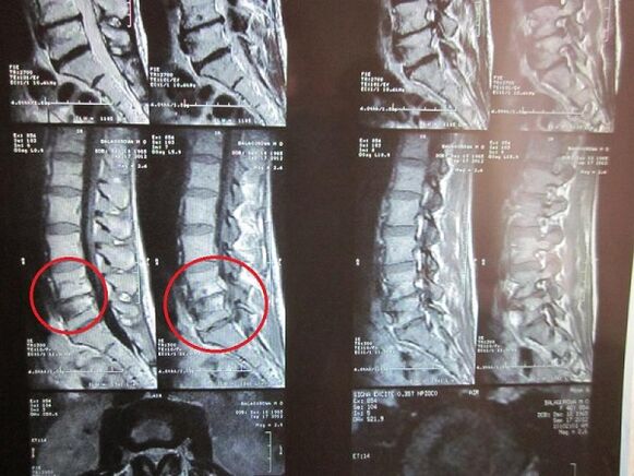 Chẩn đoán xương cổ tử cung