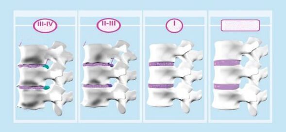 Các giai đoạn của xương cổ tử cung