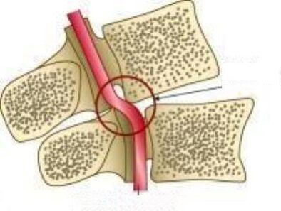 Hội chứng động mạch Vail