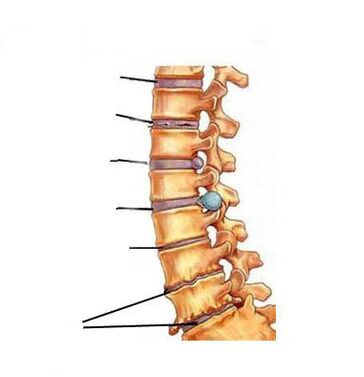 Làm thế nào bệnh xương khớp phát triển