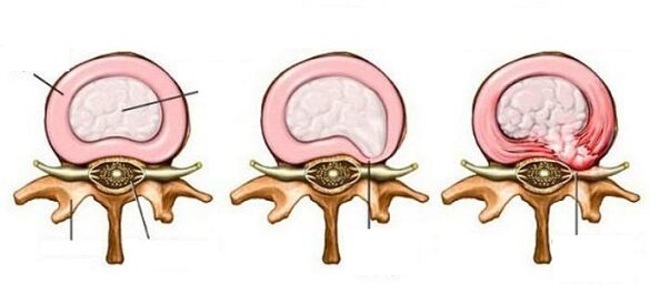 Thoát thoát vị intervertebral với bệnh xương khớp cổ tử cung