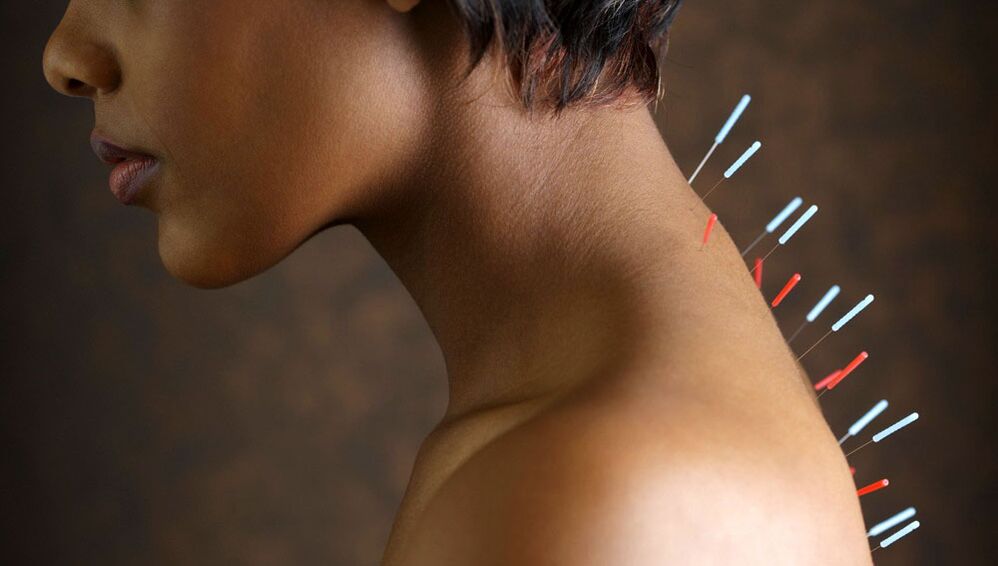 châm cứu với xương cổ tử cung