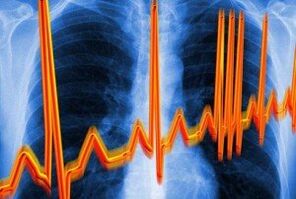 rối loạn nhịp tim cho bệnh xương khớp