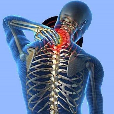 Đau cổ với bệnh xương khớp cổ tử cung