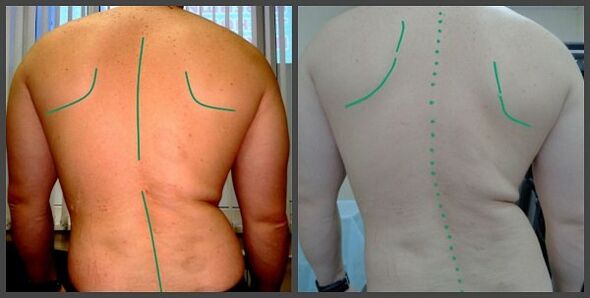 độ cong của cột sống với bệnh xương khớp