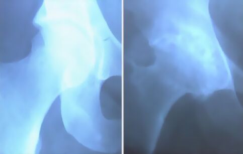 Cặn bã của khớp gối