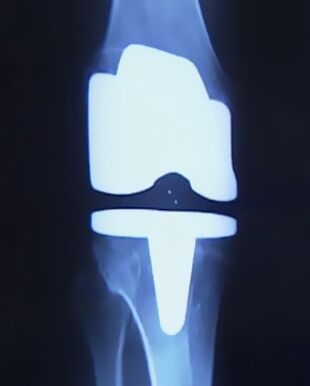 Hình ảnh của đầu gối với một chân giả nhân tạo sau khi hoạt động thay đổi khớp