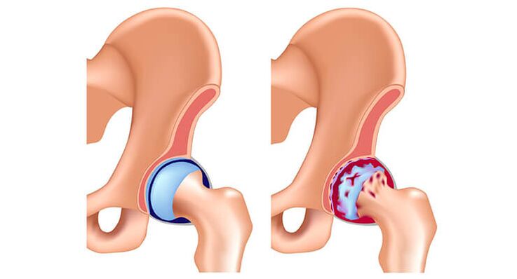 khớp hông khỏe mạnh và bị ảnh hưởng bởi bệnh khớp